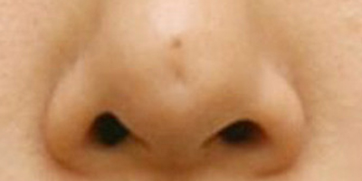 鼻部修復術(shù)前