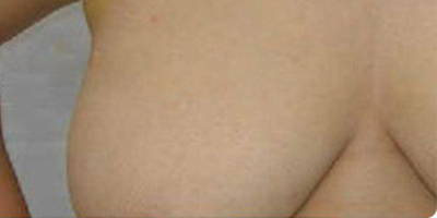吸脂去副乳術后