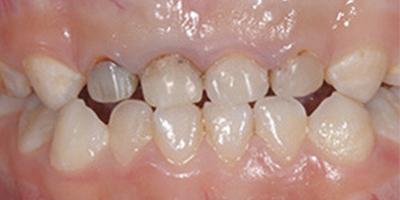 顯微鏡根管治療術(shù)后