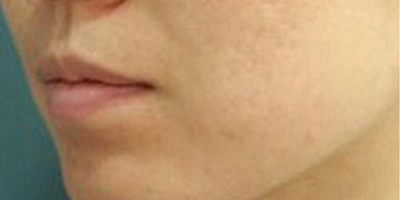 海菲秀皮膚護(hù)理術(shù)后