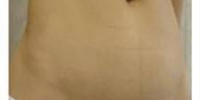 去妊娠紋術(shù)后