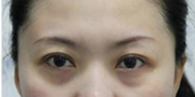 自體脂肪豐太陽穴術后