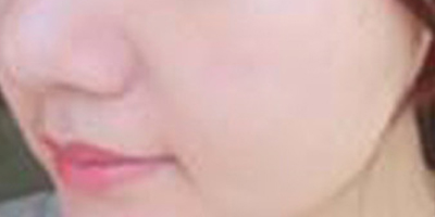 海菲秀術(shù)后