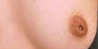 乳頭內(nèi)陷矯正術前