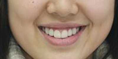 隱形托槽矯正術(shù)后