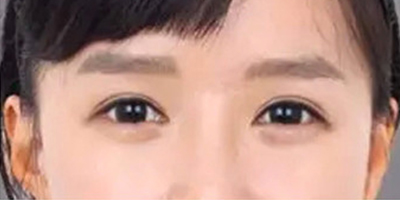 自體脂肪豐臥蠶術(shù)后