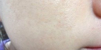 果酸煥膚術(shù)后