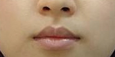 美白注射術(shù)后