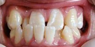 二氧化鋯全瓷牙術(shù)前