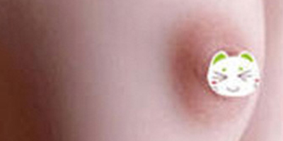 乳暈漂紅術(shù)后