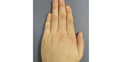 自體脂肪豐手術(shù)后