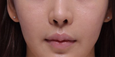 人中縮短術(shù)術(shù)后