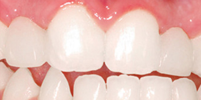 激光美白牙術(shù)后