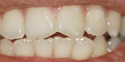 冷光美白術(shù)前