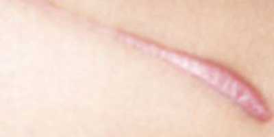 無創(chuàng)疤痕修復術前