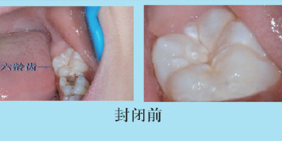 兒童口腔預防窩溝封閉術(shù)前