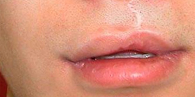 唇部修復(fù)術(shù)前