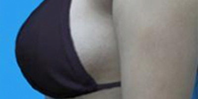 自體脂肪隆胸術后