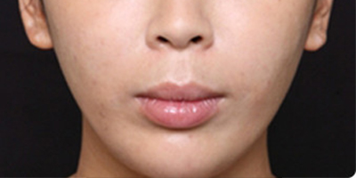 注射頦肌放松術(shù)后