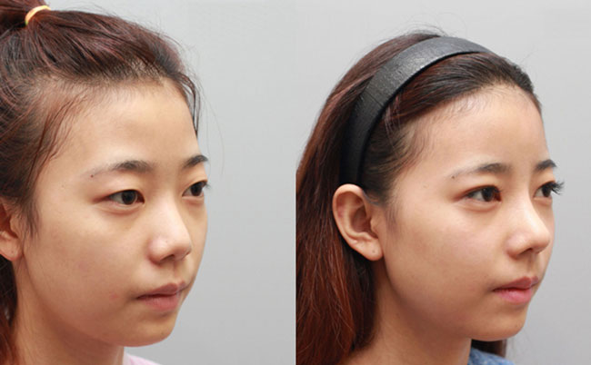耳軟骨隆鼻的優(yōu)缺點是什么？肋軟骨隆鼻和耳軟骨隆鼻有什么區(qū)別？