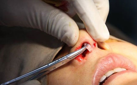 鼻子假體取出需要多少錢？取出后鼻子會恢復(fù)原來樣子嗎？