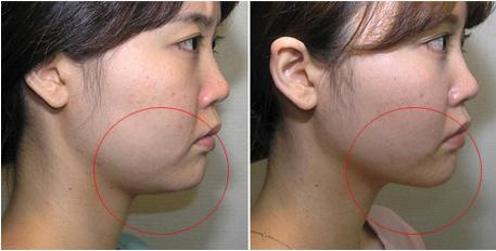 雙下巴吸脂多長時間恢復(fù)？雙下巴吸脂術(shù)能保持多久？