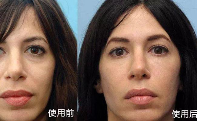 法令紋去除手術(shù)效果好嗎？法令紋怎么消除?最好的方法是什么？