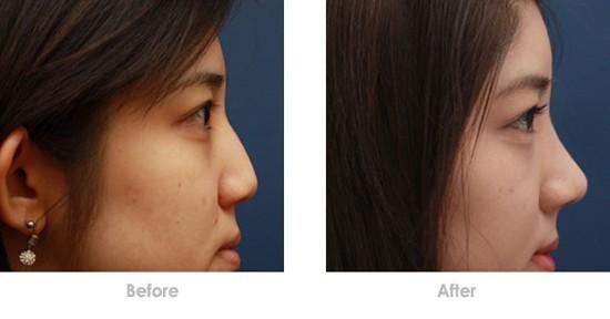 隆鼻假體取出后鼻子會不會變形？隆鼻假體取出后能不能恢復(fù)原樣？