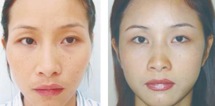 假體填充豐太陽穴怎么做？假體豐太陽穴的方法有哪些？