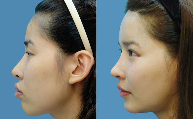 上下顎矯正術(shù)是什么手術(shù)?。肯骂M角骨骼大用什么方法去除？