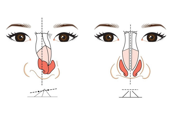 歪鼻矯正術(shù)的風(fēng)險(xiǎn)大嗎?鼻梁歪怎么矯正歪鼻的矯正及補(bǔ)救方法?