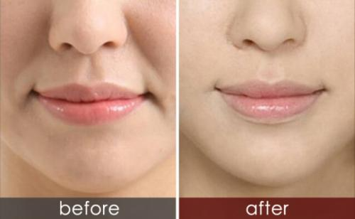 玻尿酸祛除法令紋的優(yōu)勢(shì)？玻尿酸和肉毒素祛法令紋，哪一種效果好？