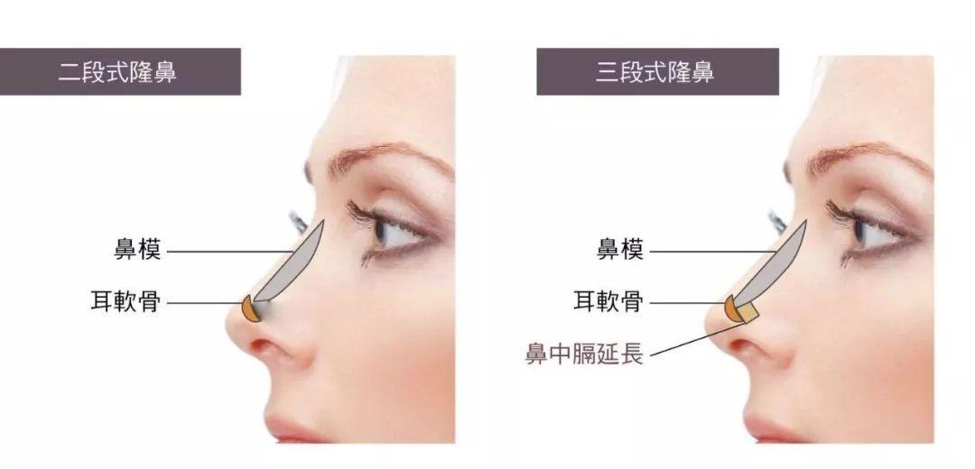 自體軟骨隆鼻的手術(shù)優(yōu)缺點有哪些?肋軟骨填充鼻基底多久能自然?