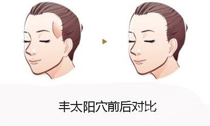 什么是自體脂肪豐太陽穴？用自體脂肪豐太陽穴的效果能維持多久？