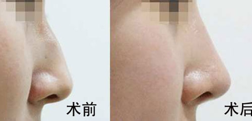 駝峰鼻矯正的方法有哪些？駝峰鼻矯正的方式及適合人群？