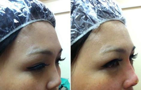 埋線手術鼻子的效果能保持多久?埋線手術隆鼻術后注意事項是什么?