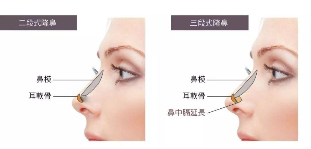 自體軟骨隆鼻的手術(shù)優(yōu)缺點有哪些？肋軟骨填充鼻基底多久能自然？