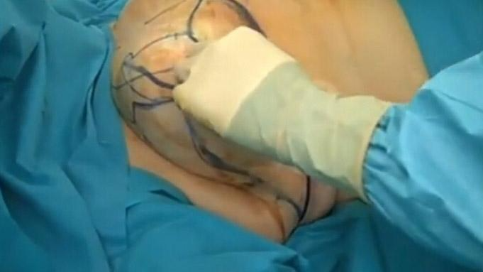 乳房縮小手術(shù)要多少錢？乳房縮小術(shù)是大手術(shù)嗎？