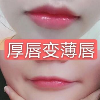 厚唇改薄整形手術(shù)價(jià)格？厚唇改薄多久完全恢復(fù)？
