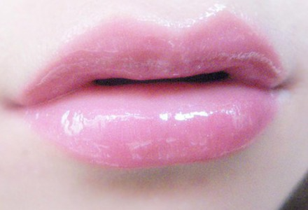 自體脂肪豐唇效果好嗎？自體脂肪豐唇大概多少錢(qián)？