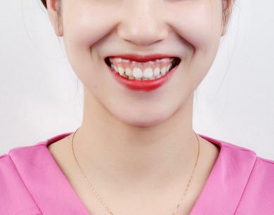 露齦笑能矯正嗎？肉毒素治療露齦笑注射量是多少？