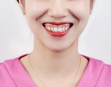 露齦笑能矯正嗎？肉毒素治療露齦笑注射量是多少？