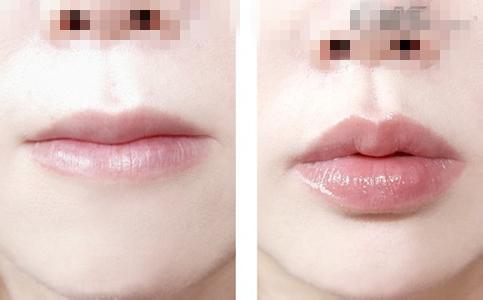 唇部綜合整形手術項目有哪些？唇部綜合整形多少錢？