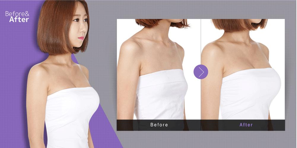 復(fù)合隆胸多少錢？復(fù)合隆胸后要注意什么？