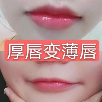 厚唇改薄整形手術(shù)價(jià)格？厚唇改薄多久完全恢復(fù)？