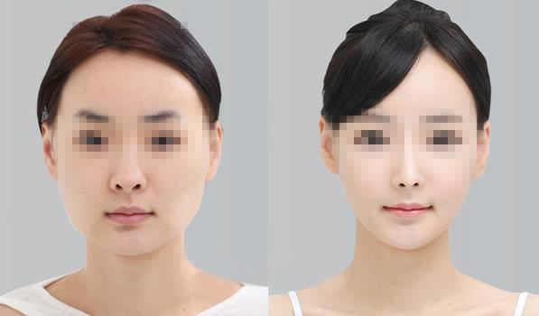 做下頜角整形手術(shù)效果好嗎？下頜角整形手術(shù)要多少錢？