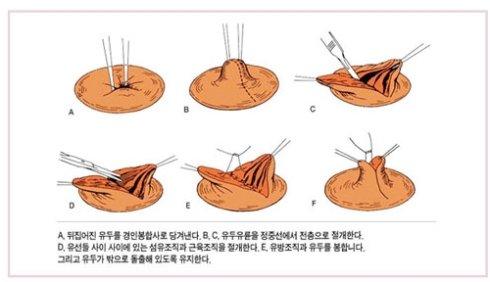 乳頭內(nèi)陷矯正手術(shù)多少錢？乳頭內(nèi)陷矯正手術(shù)多久可以恢復(fù)？