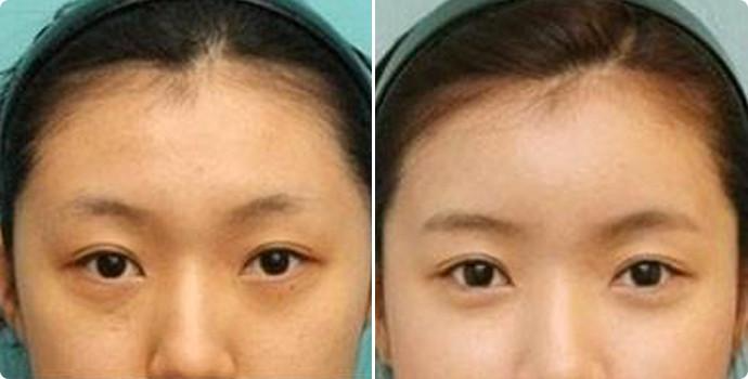 玻尿酸填充額頭效果好嗎？玻尿酸填充額頭要幾支才有效？