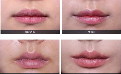 嘴角上揚(yáng)術(shù)有幾種方法？嘴角上揚(yáng)術(shù)疤痕恢復(fù)期？