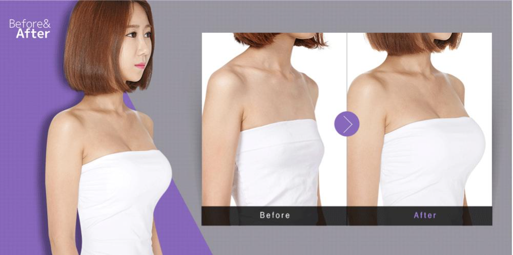 復合隆胸多少錢？復合隆胸后要注意什么？